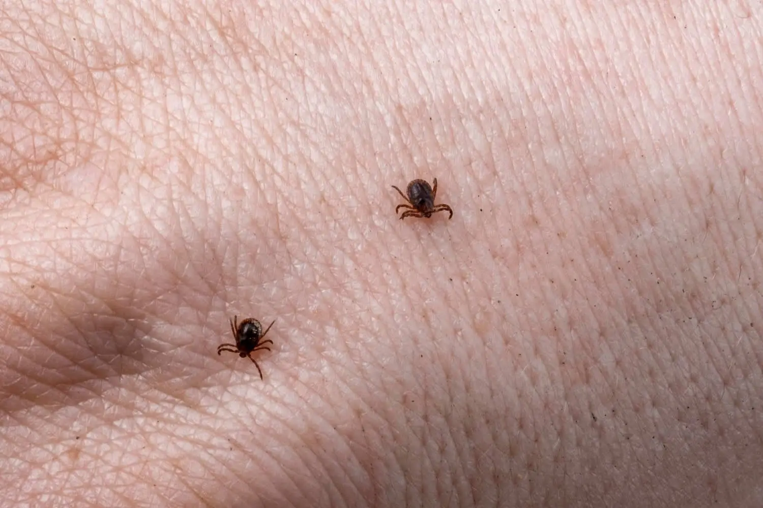 Tick Bites Treatment Rochester Dermatologist Tick Bites Treatment Rochester Dermatologist